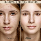 Dark Spot Remover